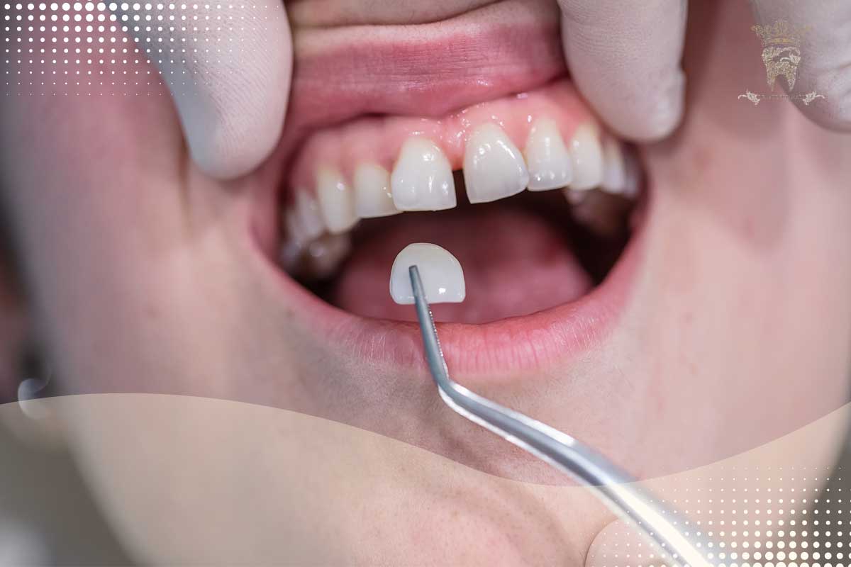 مراحل لومینیرز دندان
