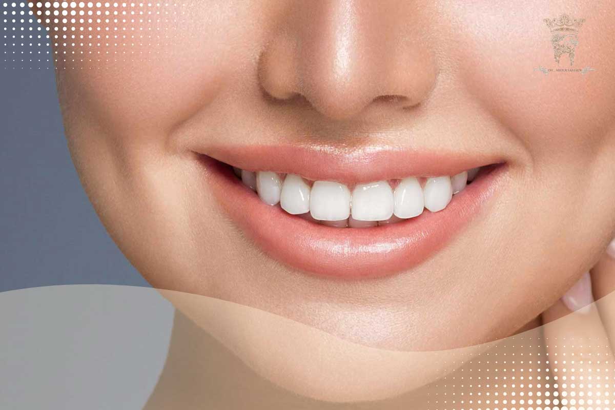 هزینه اصلاح طراحی لبخند با لمینت دندان