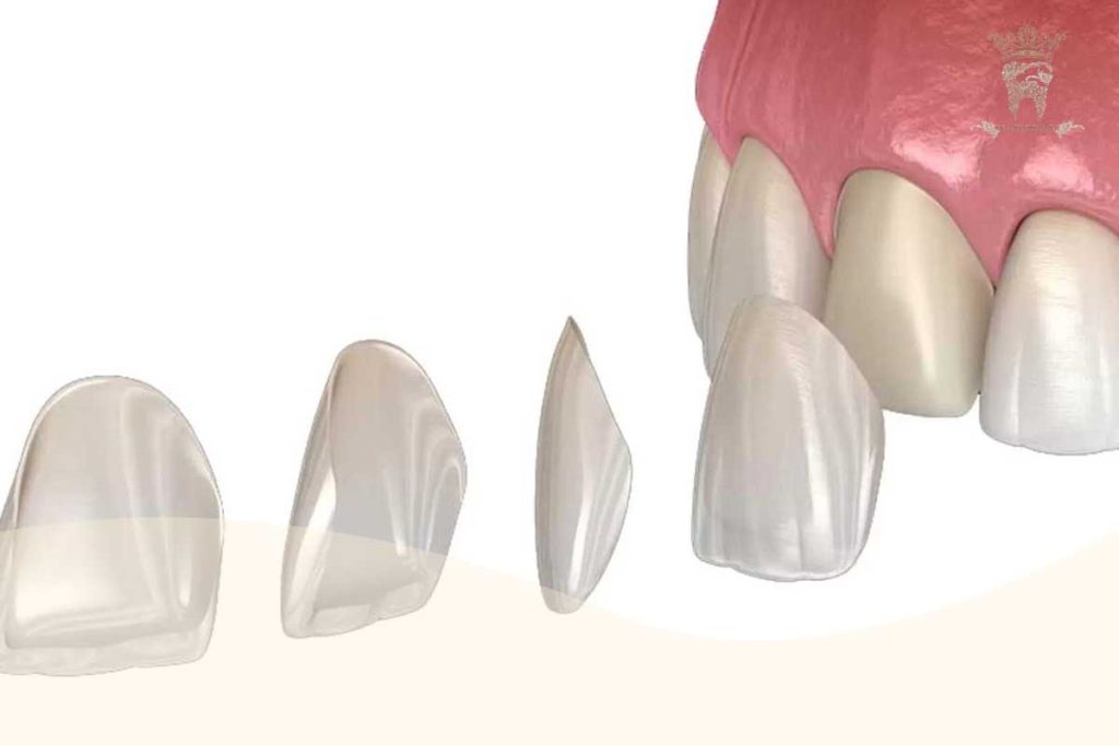 Dental ceramic veneer