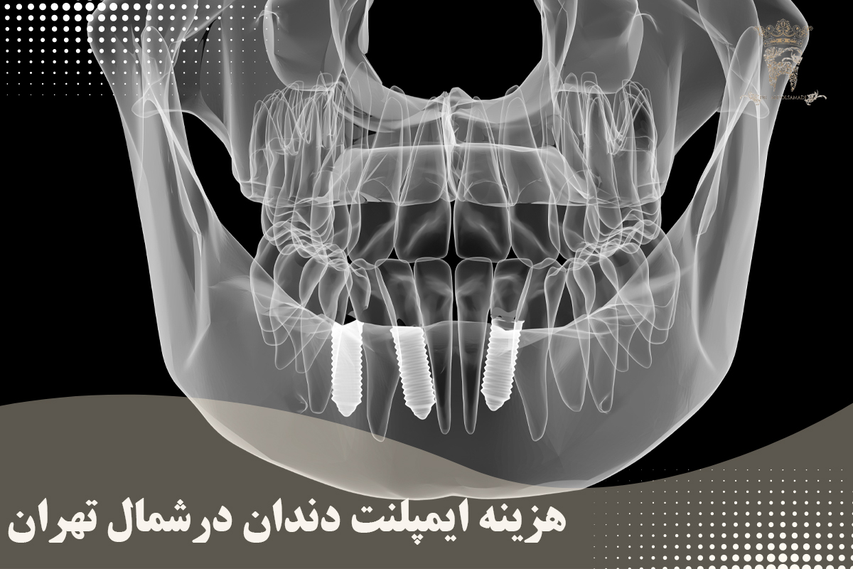 بهترین دندانپزشک ایمپلنت دندان در شمال تهران: ایمپلنت دندان در منطقه یک 8 قیمت ایمپلنت دندان در شمال تهران