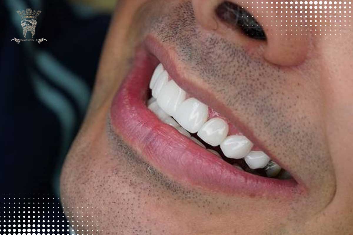 بهترین دندانپزشک ایمپلنت دندان در شمال تهران: ایمپلنت دندان در منطقه یک 7 Interdental distance in smile design correction 1
