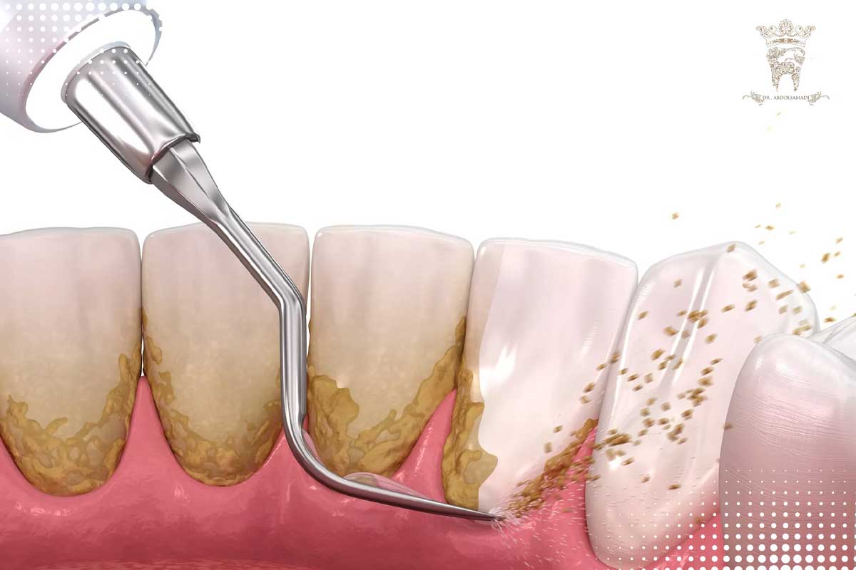 جرم گیری و روت پلنینگ