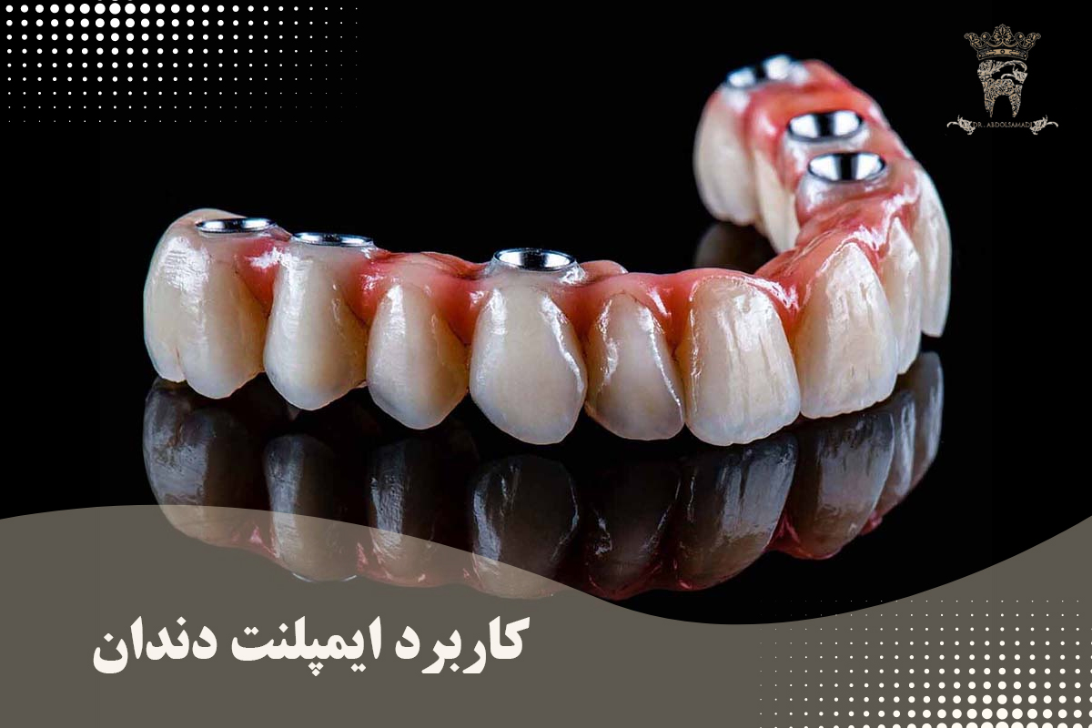 بهترین دندانپزشک ایمپلنت دندان در شمال تهران: ایمپلنت دندان در منطقه یک 1 کاربرد ایمپلنت دندان