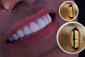 dental veneer photo before and after