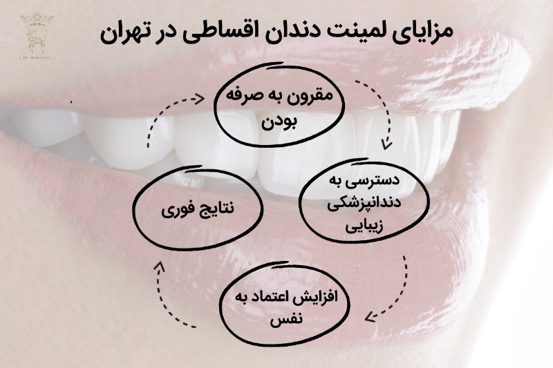 مزایای لمینت دندان اقساطی در تهران