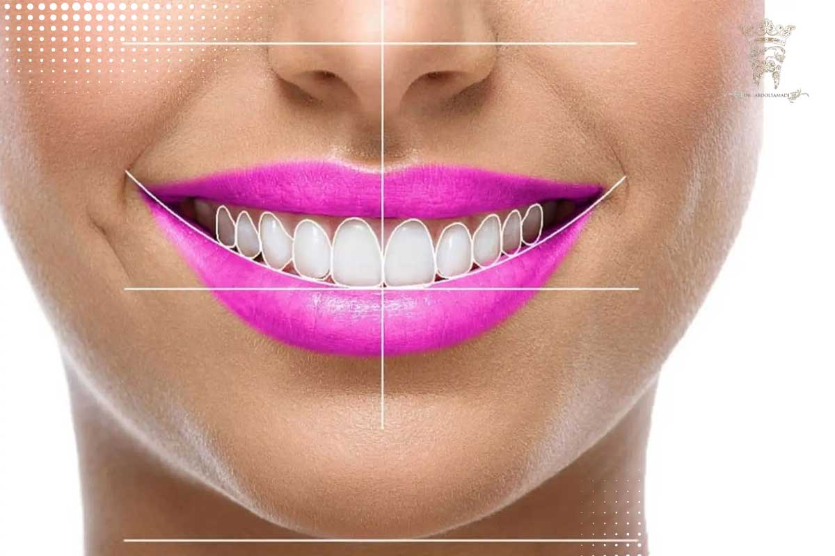 منظور از طراحی لبخند شخصی چیست؟ 2 روش های مختلف طراحی لبخند شخصی