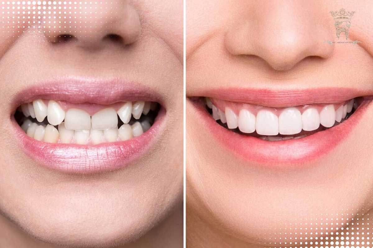 منظور از طراحی لبخند شخصی چیست؟ 3 روش تشخیص درمان مناسب برای طراحی لبخند شخصی