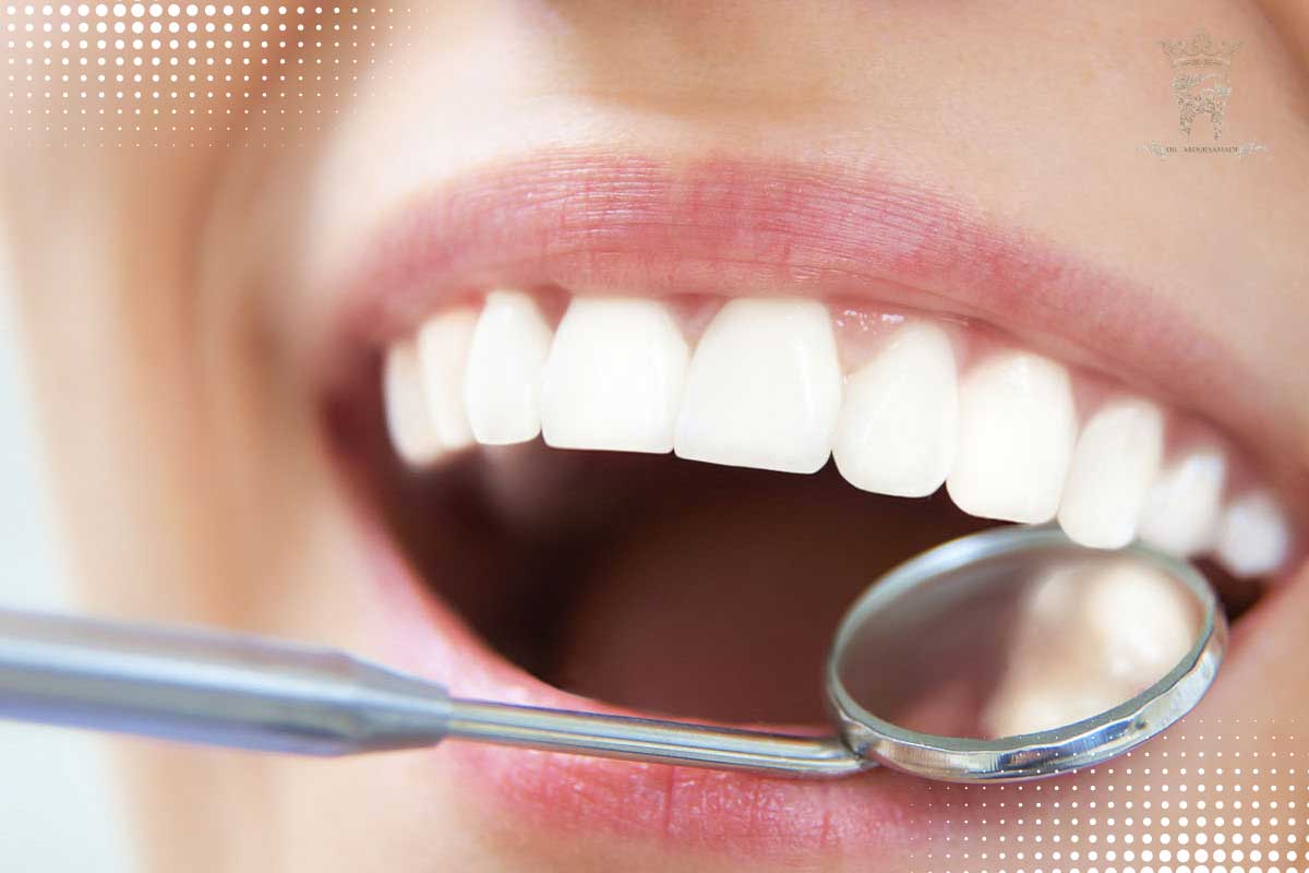 منظور از روکش دندان یک روزه یا فوری چیست؟ 4 سوالات روکش دندان یک روزه