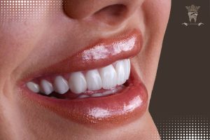 قیمت لمینت دندان