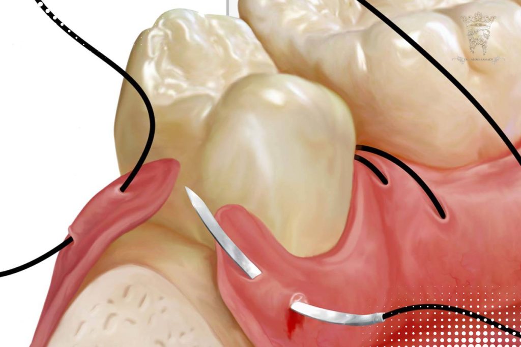 بخیه دندان در جراحی‌های دندانپزشکی