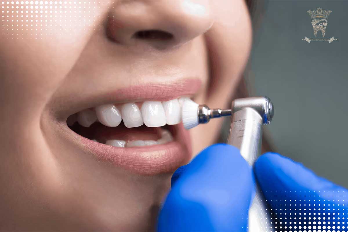 Factors affecting the price of dental laminate