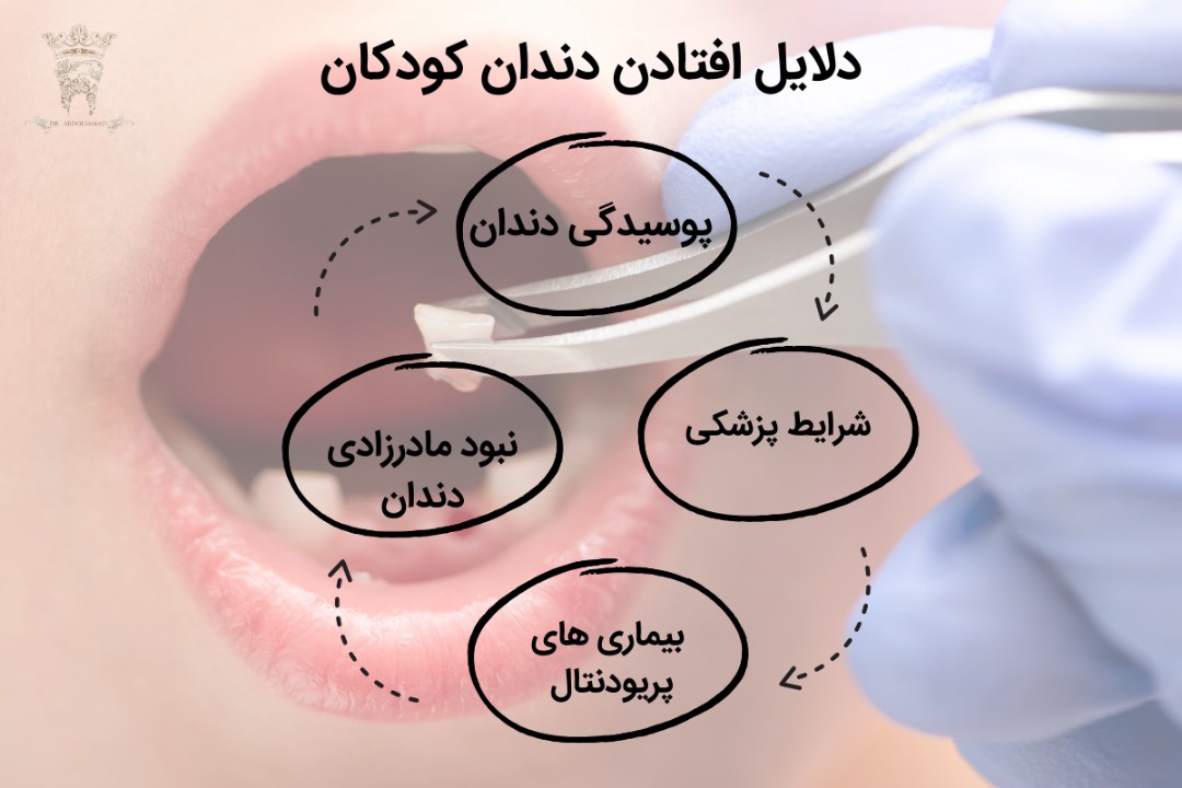 دلایل افتادن دندان کودکان 