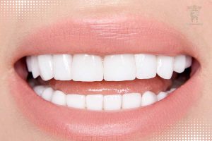 تغییر رنگ لمینت دندان