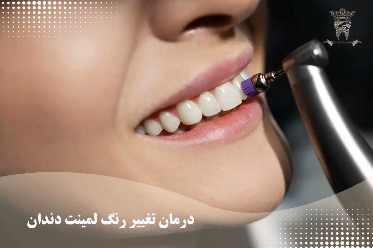 علت تغییر رنگ لمینت دندان و روشهای جلوگیری از آن 2 درمان تغییر رنگ لمینت دندان