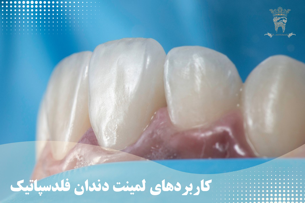 لمینت دندان فلدسپاتیک چیست و چه کاربردی دارد؟ 1 کاربردهای لمینت دندان فلدسپاتیک