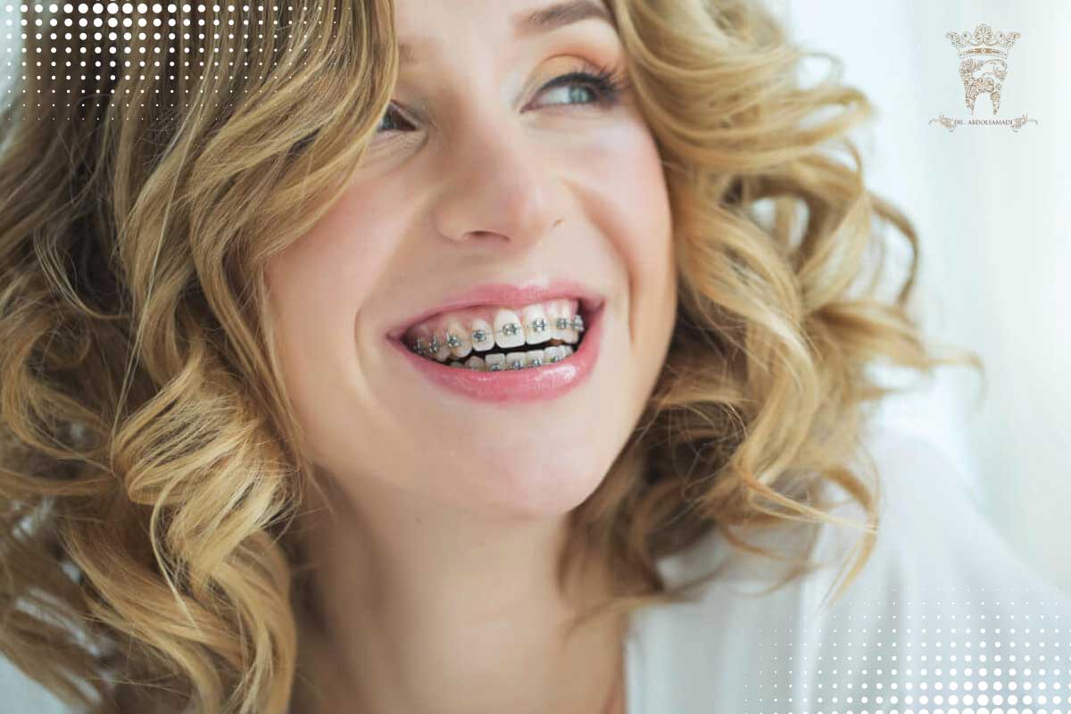 ارتودنسی به روش دیمون چیست و چه مزایایی دارد؟ 2 اتنتخاب ارتودنسی دیمون