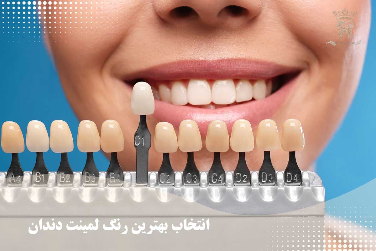 سفیدترین رنگ لمینت دندان کدام است؟ 3 انتخاب بهترین رنگ لمینت دندان