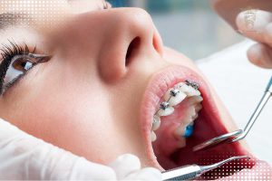 ارتودنسی به روش دیمون