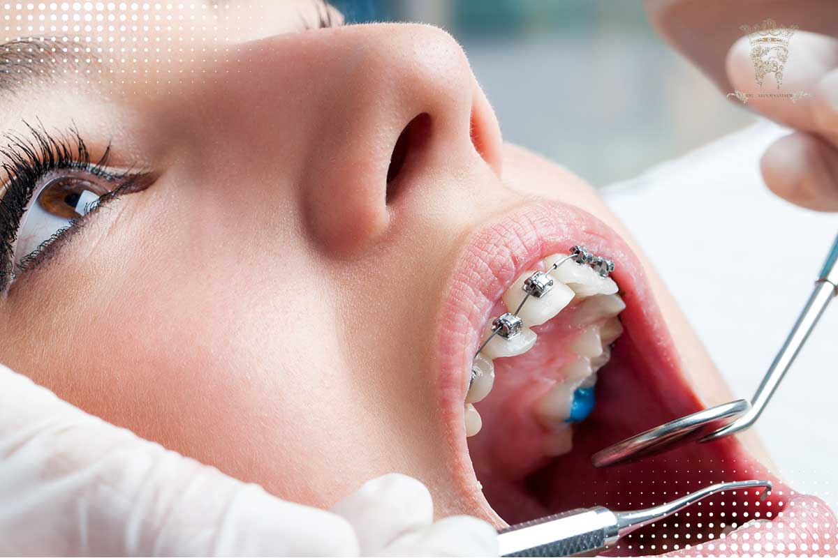 ارتودنسی به روش دیمون