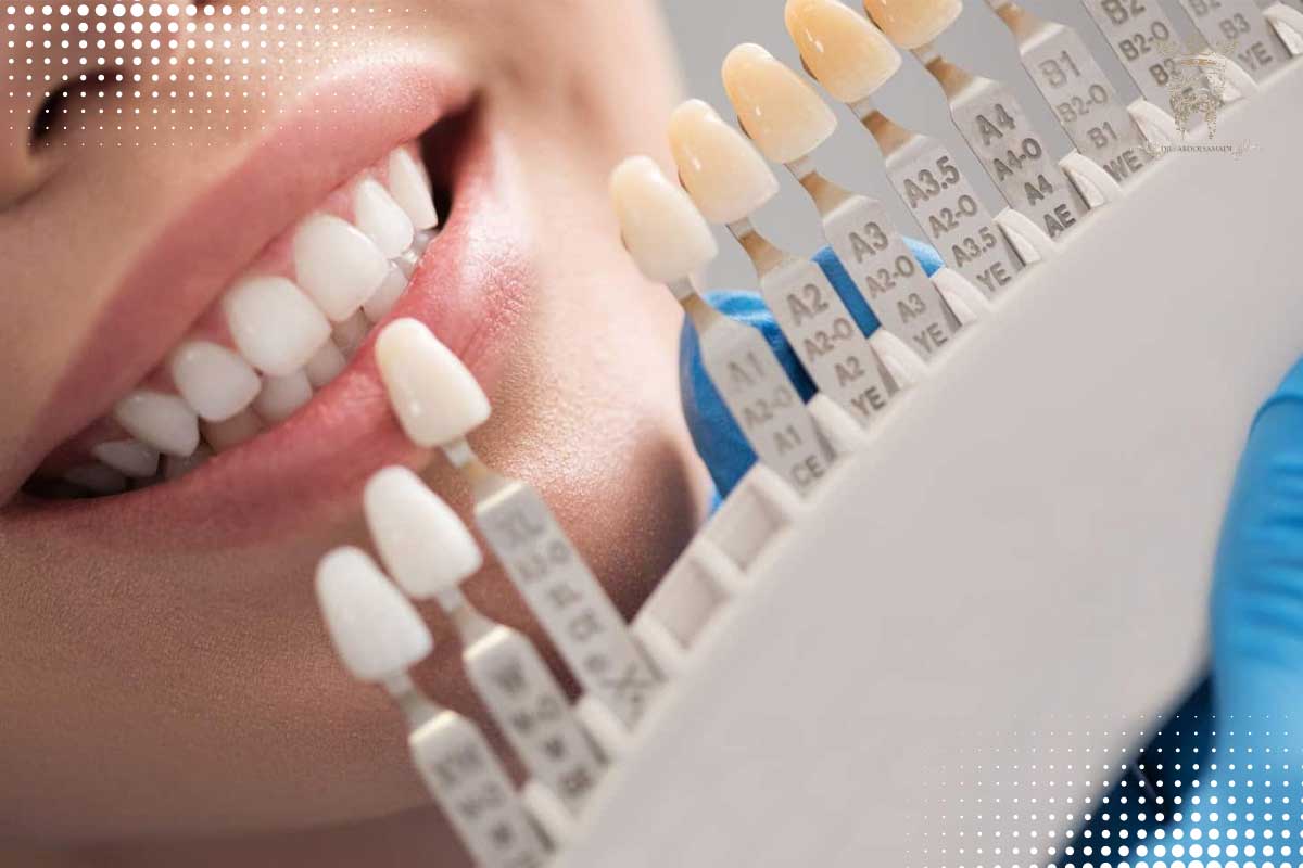 سفیدترین رنگ لمینت دندان کدام است؟ 2 انواع مختلف رنگ لمینت دندان