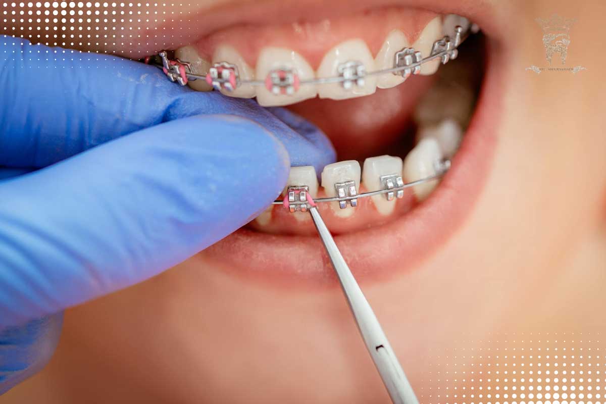 ارتودنسی به روش دیمون چیست و چه مزایایی دارد؟ 4 معایب ارتودنسی دیمون