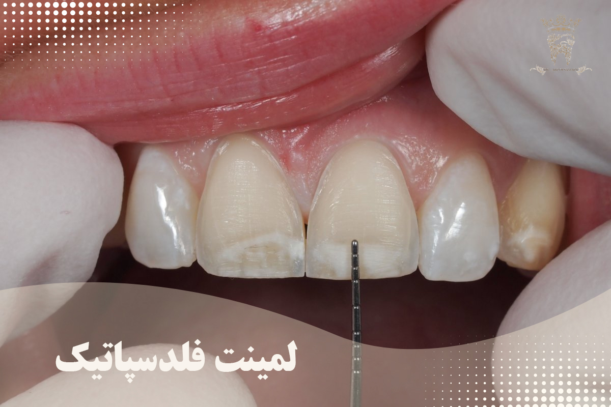 لمینت دندان فلدسپاتیک چیست و چه کاربردی دارد؟ 4 مقاومت لمینت دندان فلدسپاتیک