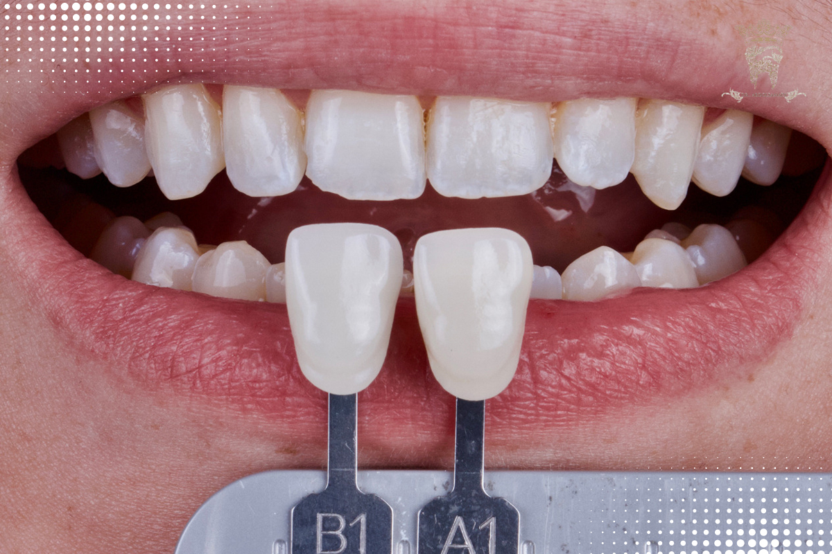 لمینت دندان فلدسپاتیک چیست و چه کاربردی دارد؟ 6 نحوه نگهداری از لمینت دندان فلدسپاتیک