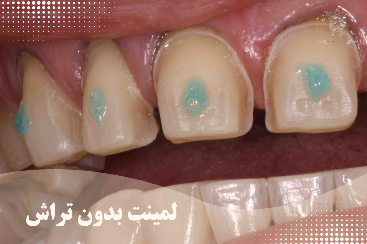 لمینت دندان بدون تراش در تهران؛ انتخابی ایدهآل برای اصلاح طرح لبخند 18 لمینت بدون تراش