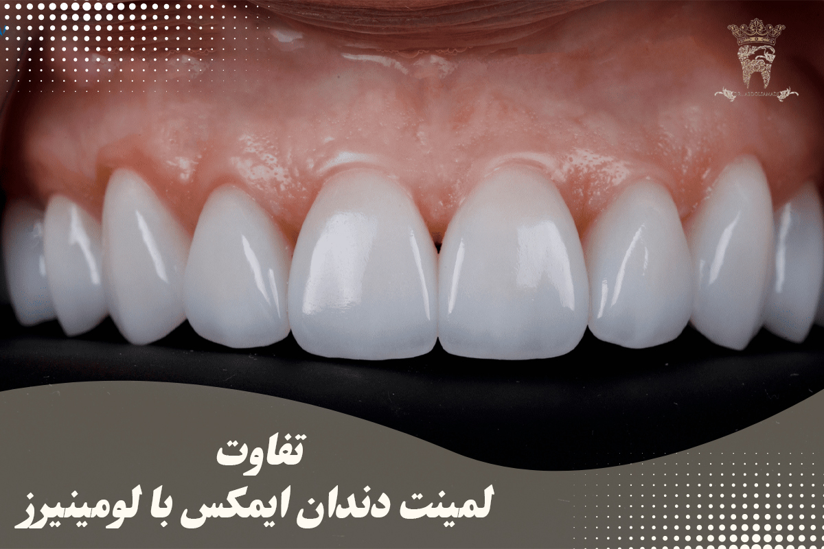 همه چیز در مورد لمینت دندان ایمکس (مزایا و معایب لمینت ایمکس) 11 تفاوت لمینت دندان ایمکس با لومینیرز