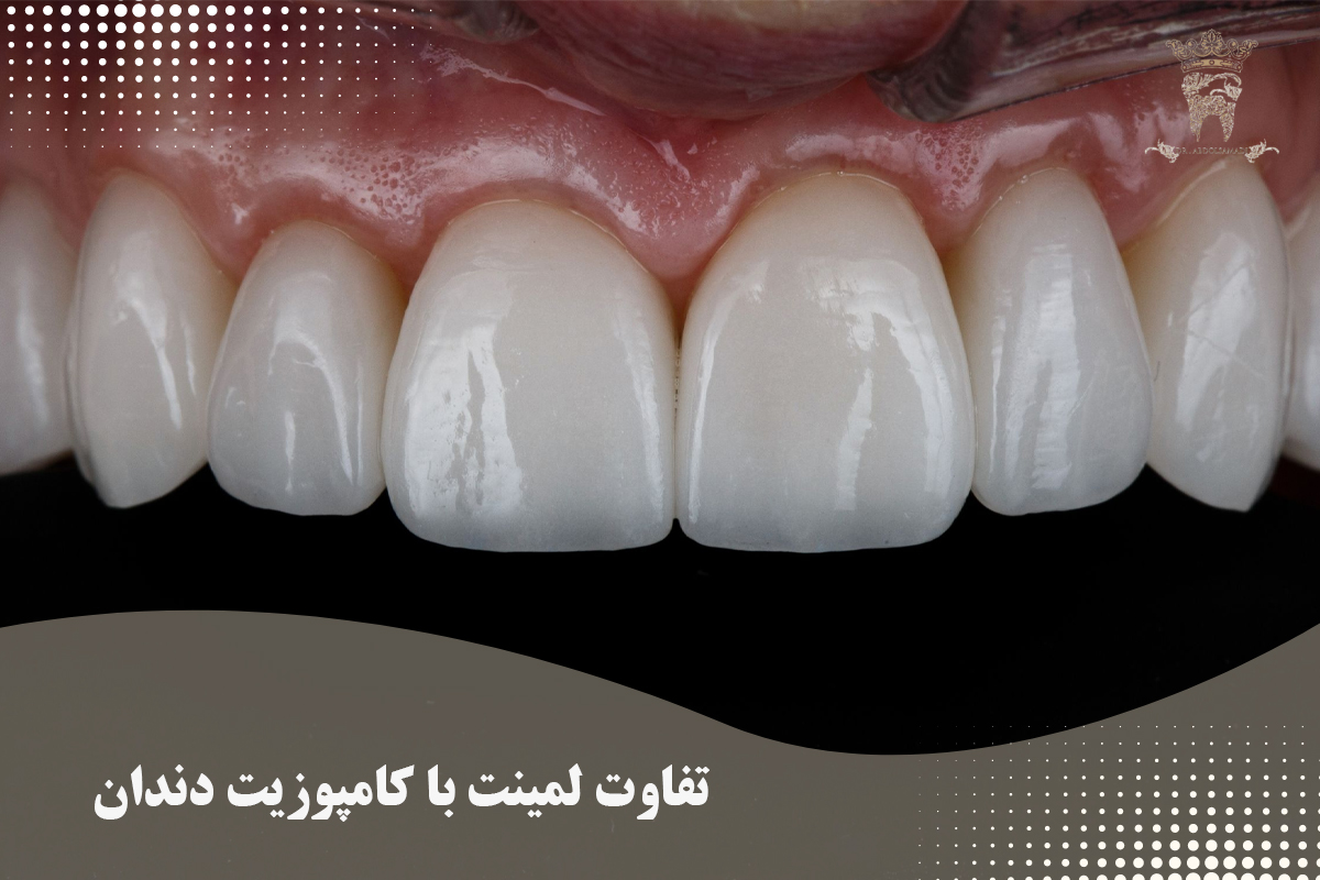 کامپوزیت دندان یا لمینت: بررسی مزایا و معایب هر کدام 4 تفاوت لمینت با کامپوزیت دندان