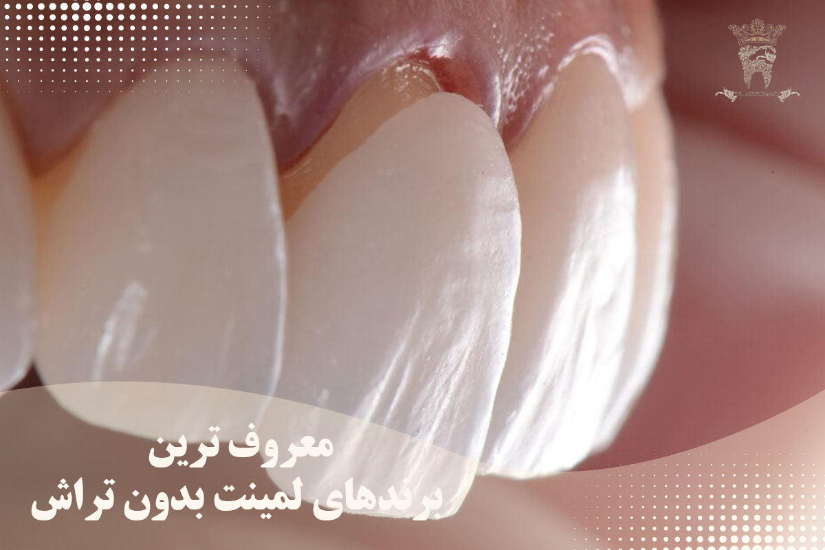لمینت دندان بدون تراش در تهران؛ انتخابی ایدهآل برای اصلاح طرح لبخند 2 معروف ترین برندهای لمینت بدون تراش