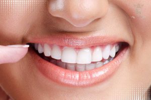 سفیدترین رنگ لمینت دندان
