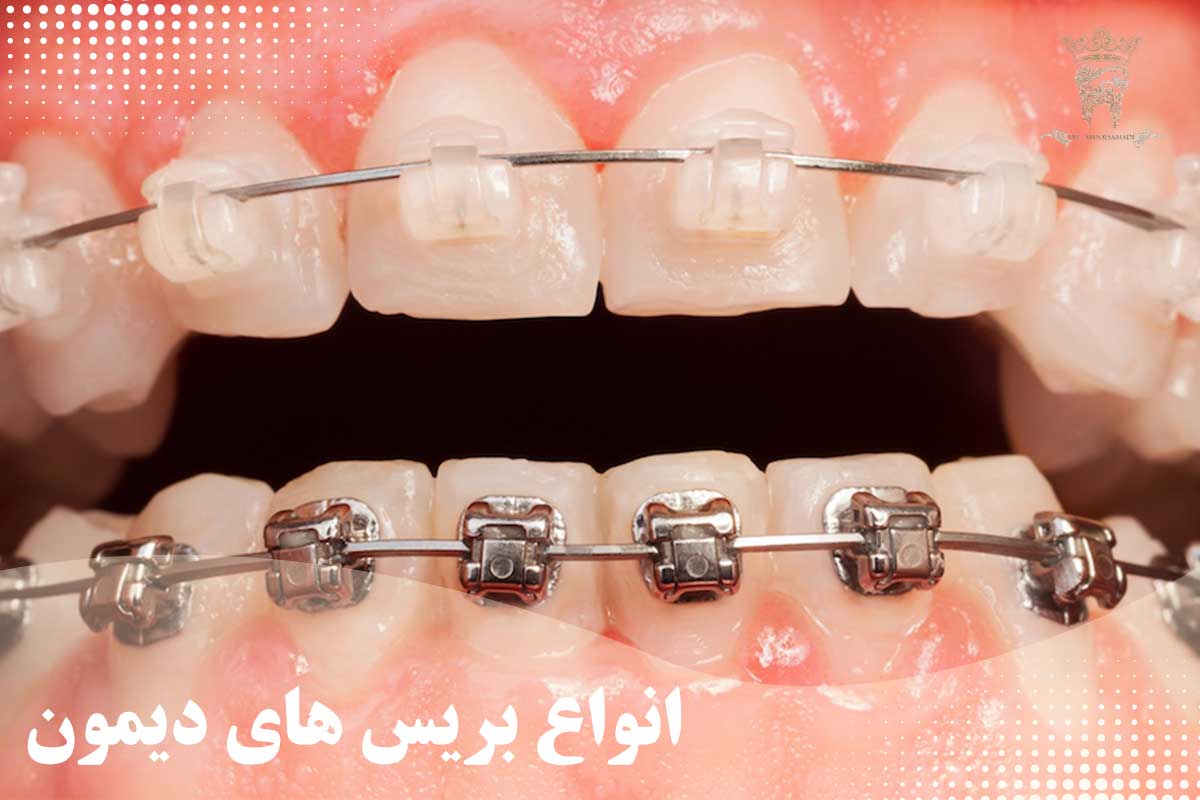 ارتودنسی به روش دیمون چیست و چه مزایایی دارد؟ 1 انواع بریس های دیمون
