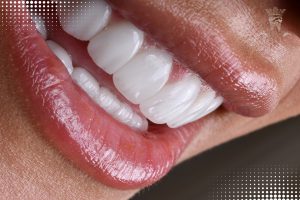روکش دندان تمام سرامیکی
