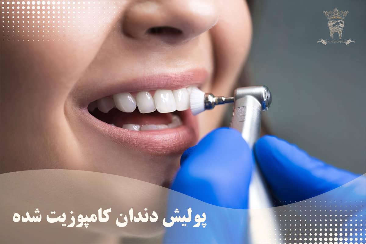پالیش دندان چیست و چه کاربردی دارد؟ 2 پولیش دندان کامپوزیت شده