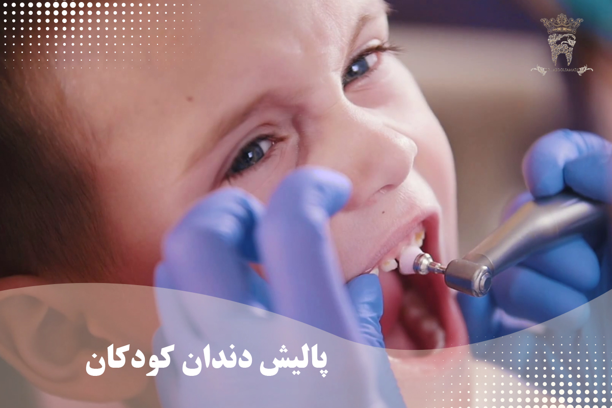 پالیش دندان چیست و چه کاربردی دارد؟ 5 پالیش دندان کودکان