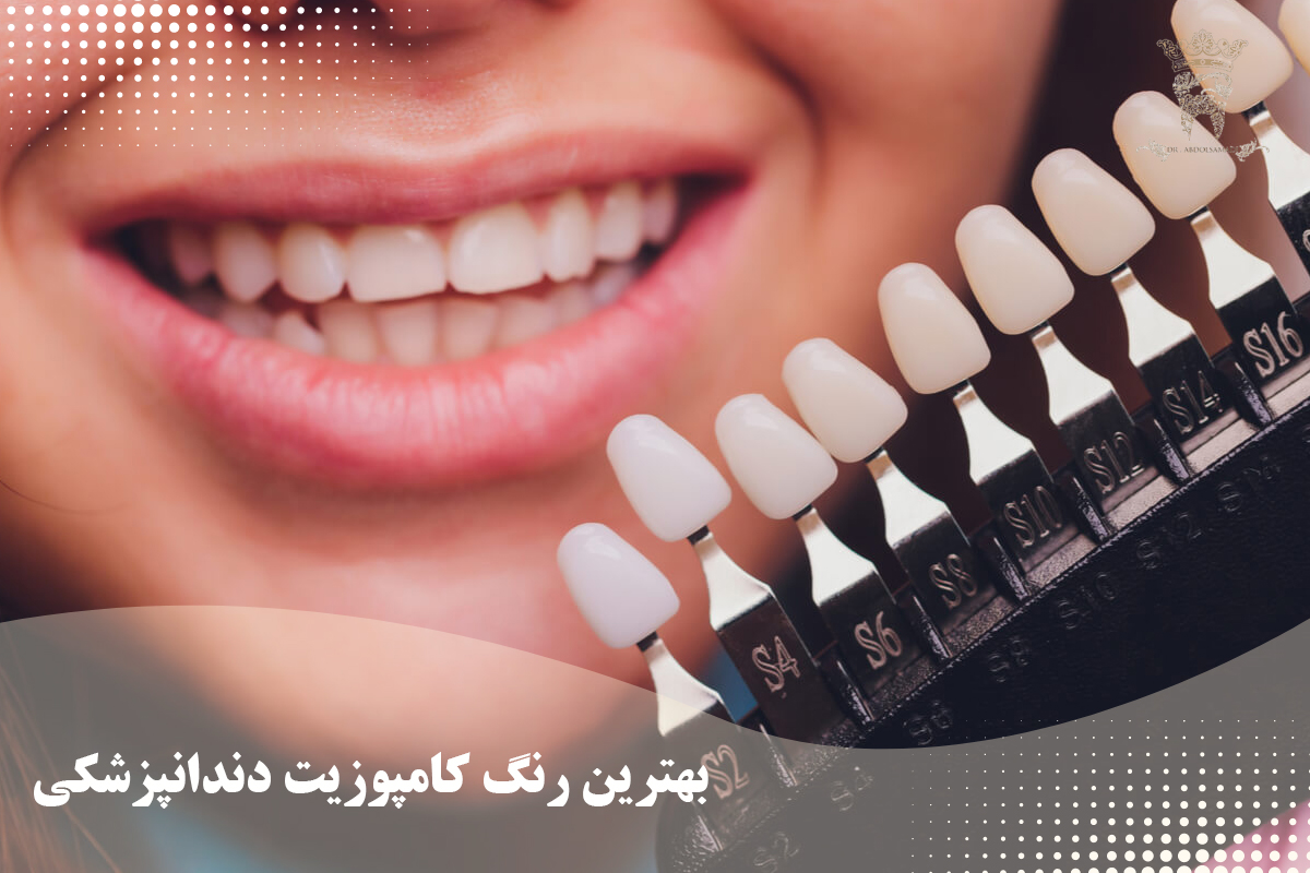 مزایا و معایب کامپوزیت دندانپزشکی: یک بررسی جامع 5 بهترین رنگ کامپوزیت دندان