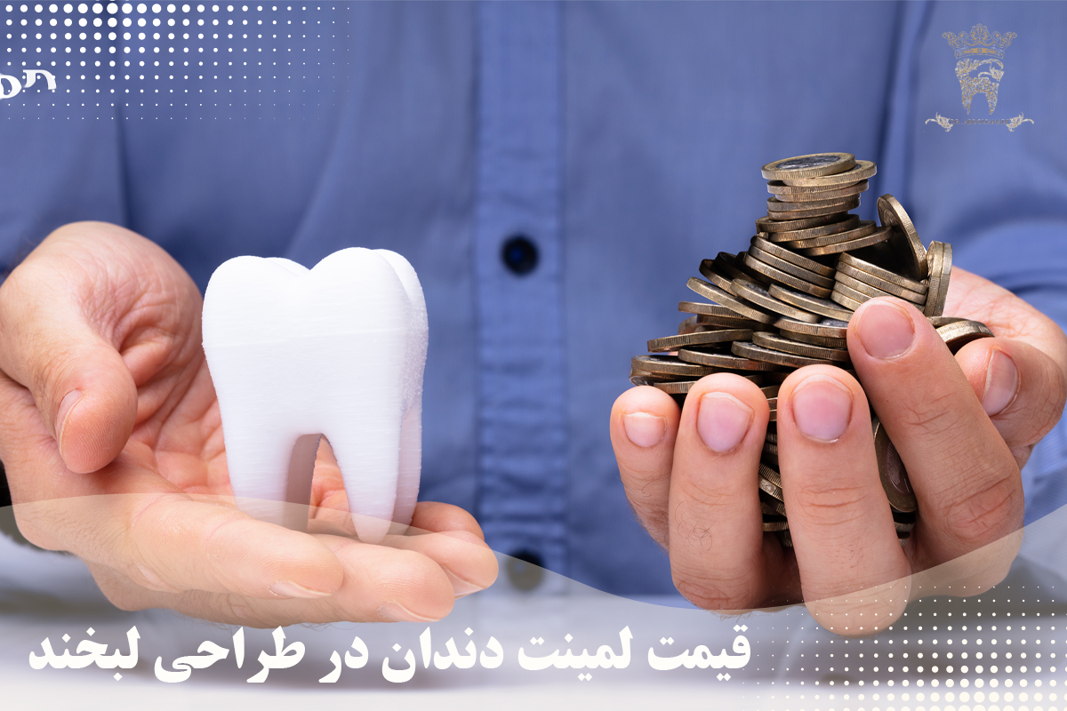قیمت لمینت دندان 1404 (لمینت دندان در تهران) 14 قیمت لمینت دندان در طراحی لبخند