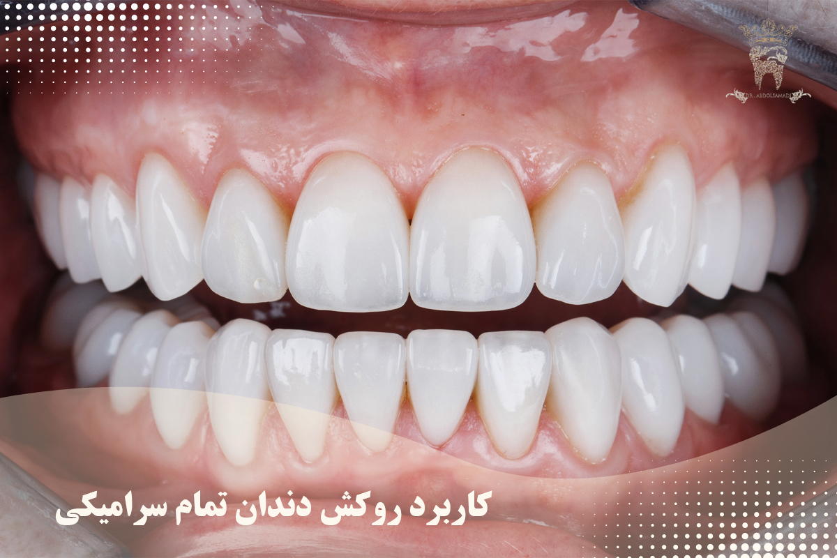 کاربرد و مزایای روکش دندان تمام سرامیکی 1 کاربرد روکش دندان تمام سرامیکی