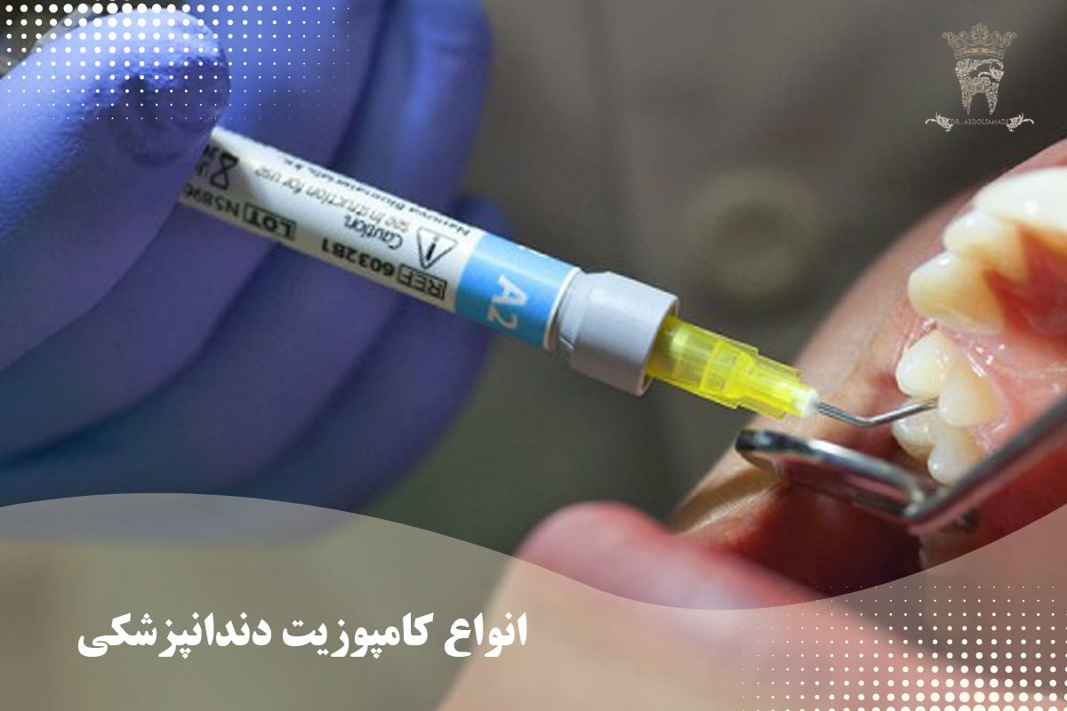 مزایا و معایب کامپوزیت دندانپزشکی: یک بررسی جامع 2 انواع کامپوزیت دندانپزشکی