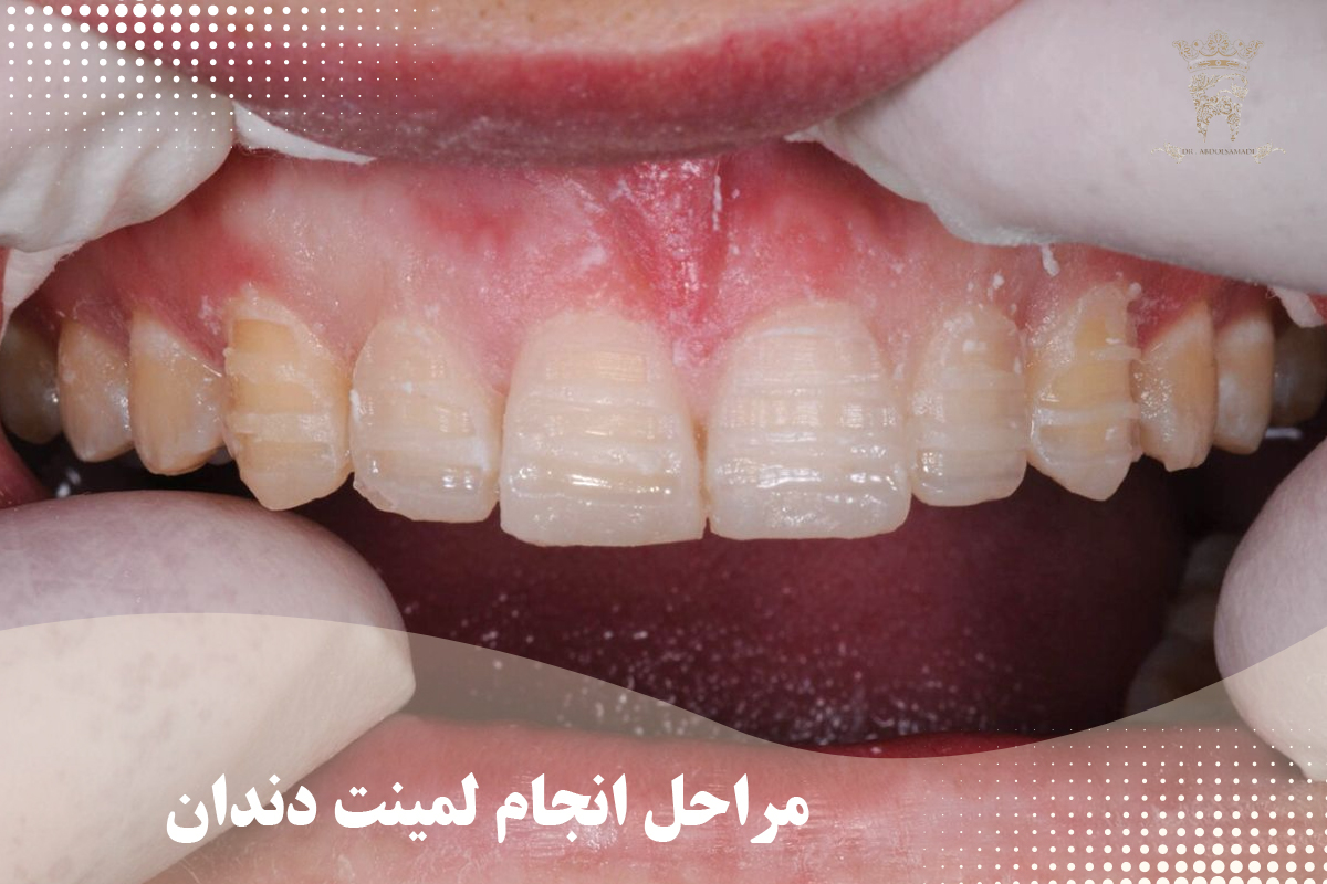 لمینت دندان بالا به چه صورت است؟ 2 مراحل لمینت دندان بالا