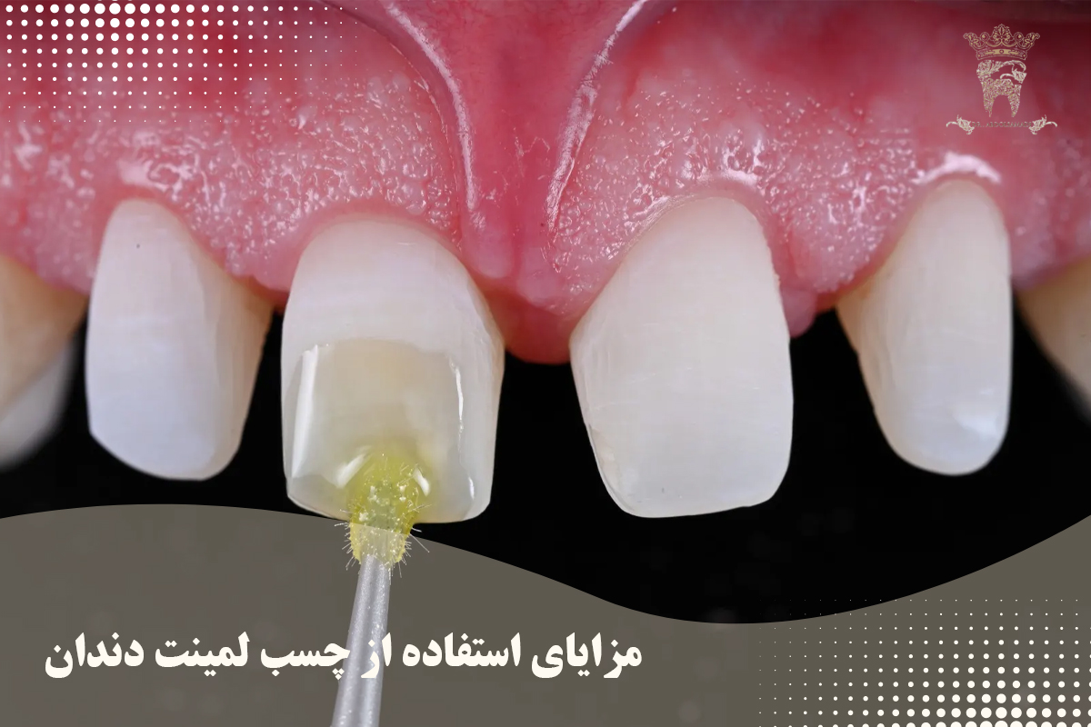 معرفی انواع چسب لمینت دندان (دکتر عبدالصمدی) 4 مزایای استفاده از چسب لمینت دندان