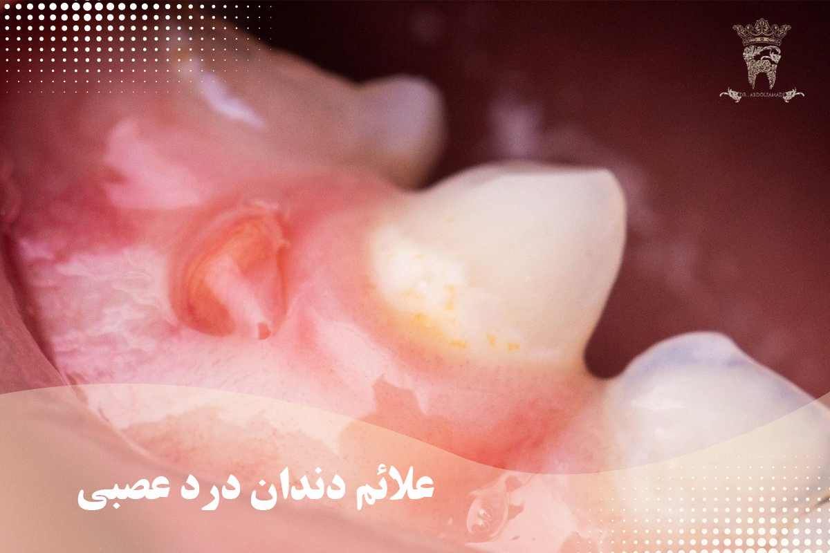 بررسی علت دندان درد عصبی و درمان آن 1 علائم دندان درد عصبی
