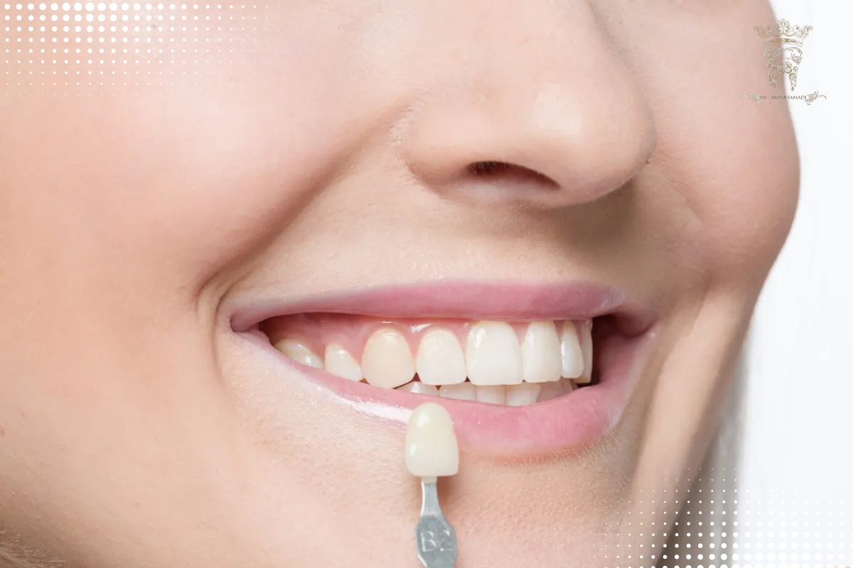 منظور از هر واحد لمینت دندان چیست؟ (دکتر عبدالصمدی) 4 تعداد واحد لمینت