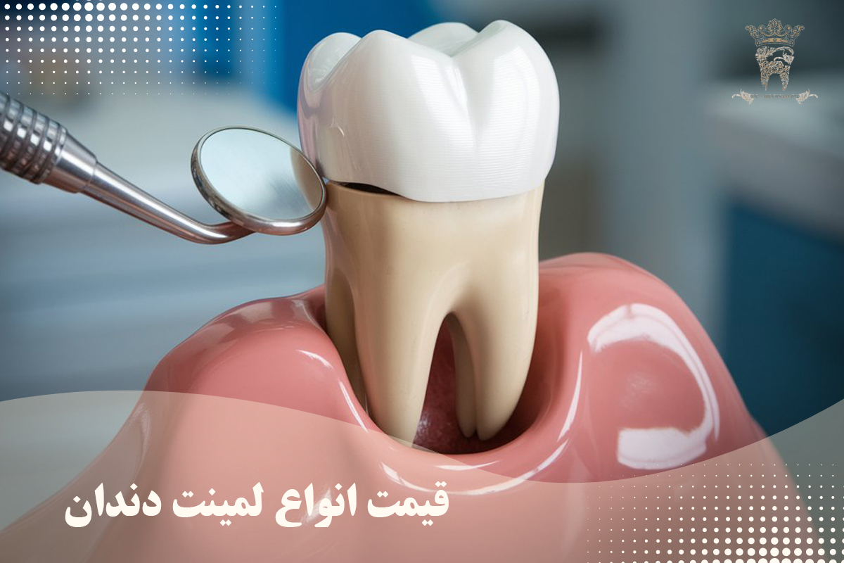 بررسی انواع لمینت دندان (انواع لمینت دندان از نظر برند و بررسی قیمت لمینت دندان) 4 قیمت انواع لمینت دندان