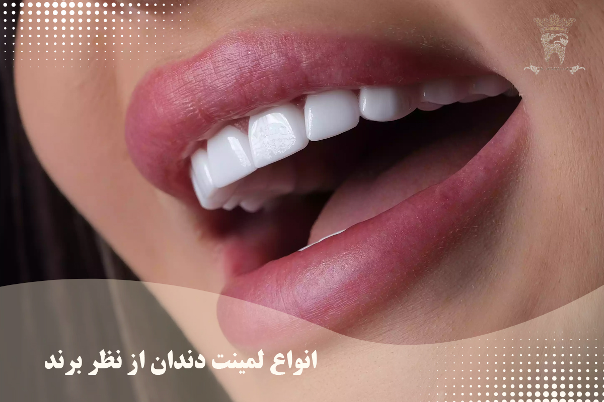 بررسی انواع لمینت دندان (انواع لمینت دندان از نظر برند و بررسی قیمت لمینت دندان) 1 انواع لمینت دندان از نظر برند