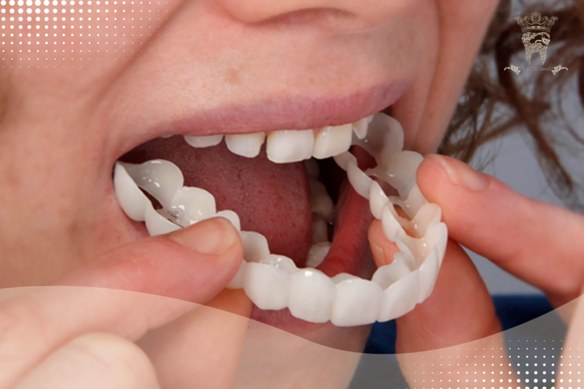 لمینت متحرک دندان؛ مزایا و قیمت خرید 4 لمینت متحرک دندان برای چه کسانی مناسب است؟