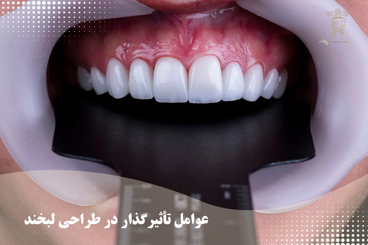 طراحی لبخند دندان در مرکز دندانپزشکی دکتر عبدالصمدی 5 عوامل تأثیرگذار در طراحی لبخند
