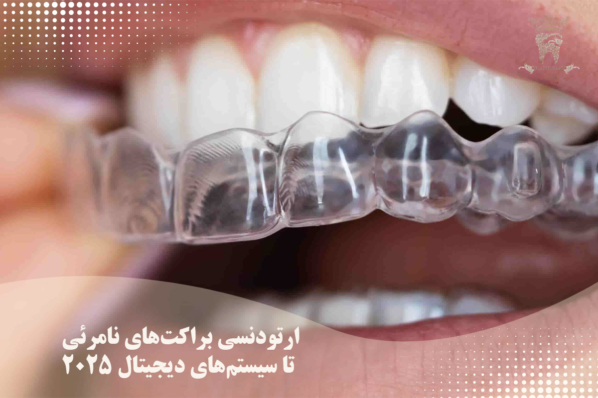 جدیدترین متد درمان های زیبایی دندان در سال 2025 (دکتر عبدالصمدی) 2 ارتودنسی براکتهای نامرئی