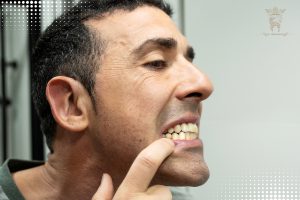 آسیب کامپوزیت به دندان
